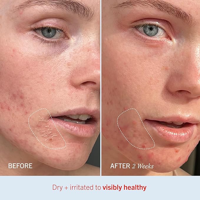 First Aid Beauty - Ultra Repair Cream, Intense Hydration Whipped Colloidal Oatmeal, Clinically Proven to Strengthen Skin Barrier in 7 Days & Helps Relieve Eczema, Luxury Face & Body Moisturizer, 8 oz